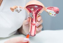 private coil fitting cost