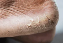 what causes white dry skin on feet