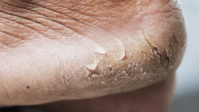 what causes white dry skin on feet