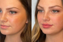 lip filler before and after