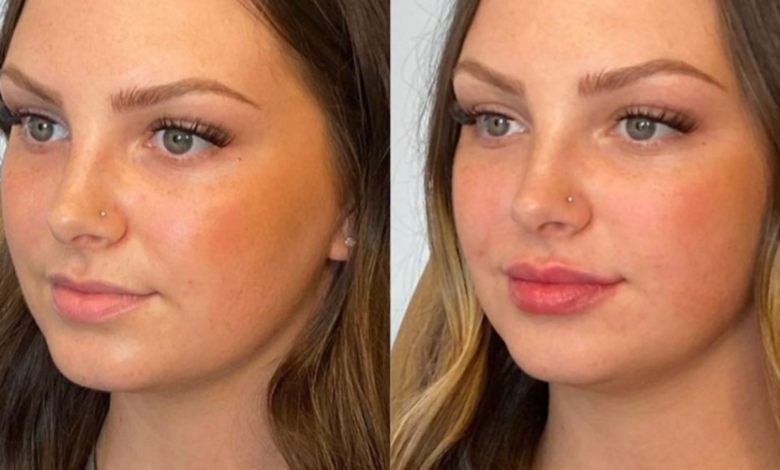 lip filler before and after